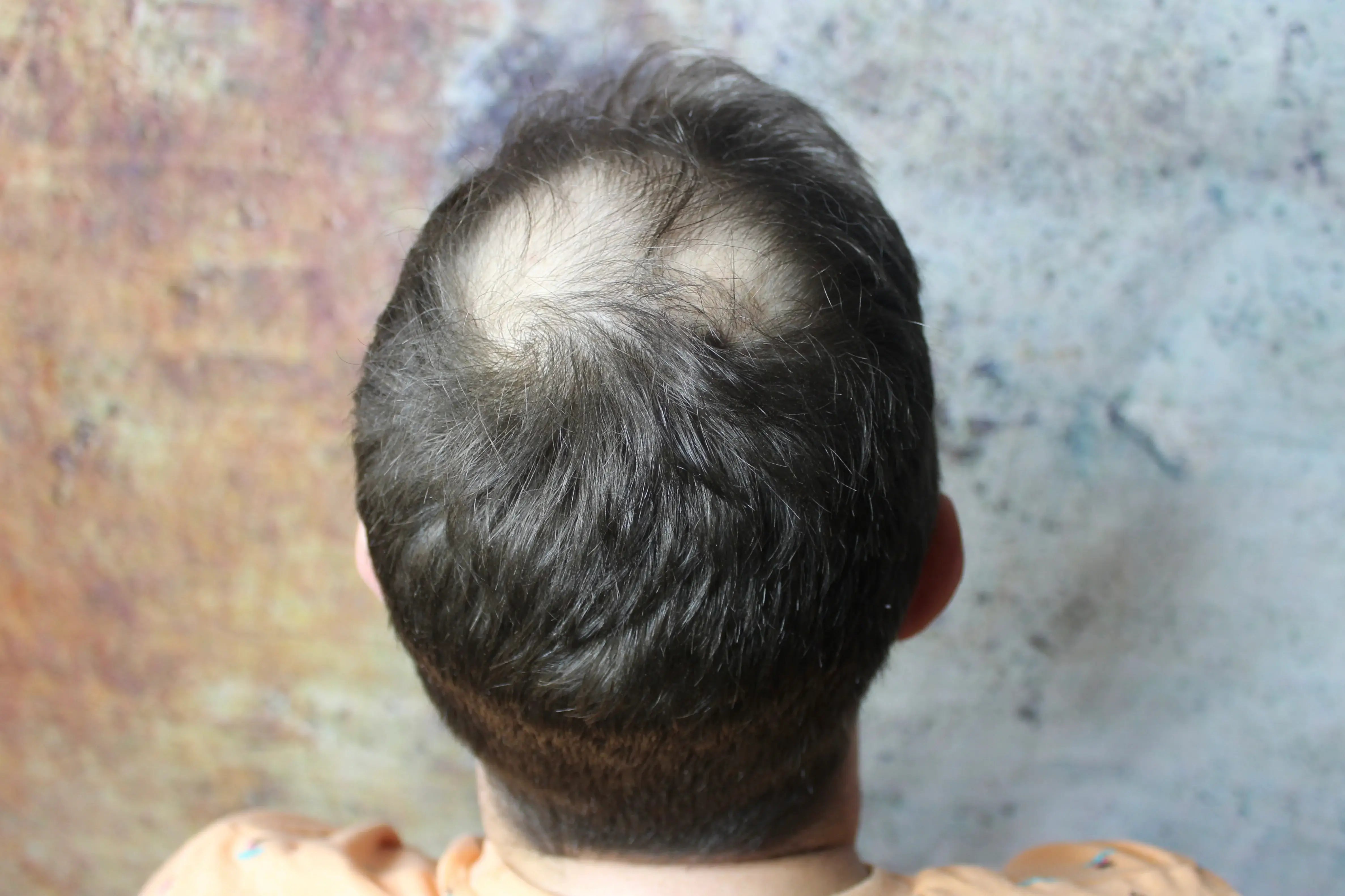 Homme avec des zones dégarnies appliquant le spray de poudre capillaire fiberhair pour améliorer immédiatement le volume et la densité des cheveux